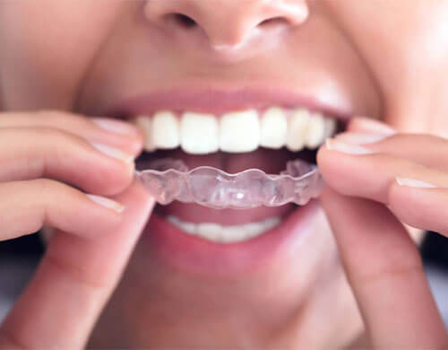 BEST INVISALIGN CLINIC IN KELLYS